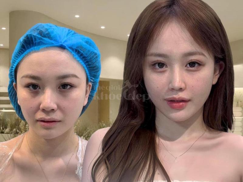 Má đầy đặn – gương mặt trẻ trung, phúc hậu và thu hút tài lộc với tiêm má Baby. - 1/4