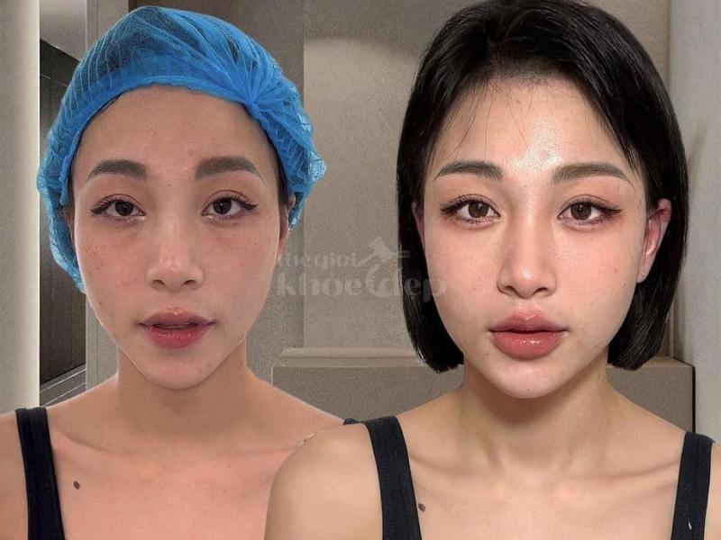 Má đầy đặn – gương mặt trẻ trung, phúc hậu và thu hút tài lộc với tiêm má Baby. - 2/4