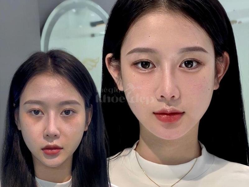 Má đầy đặn – gương mặt trẻ trung, phúc hậu và thu hút tài lộc với tiêm má Baby. - 3/4