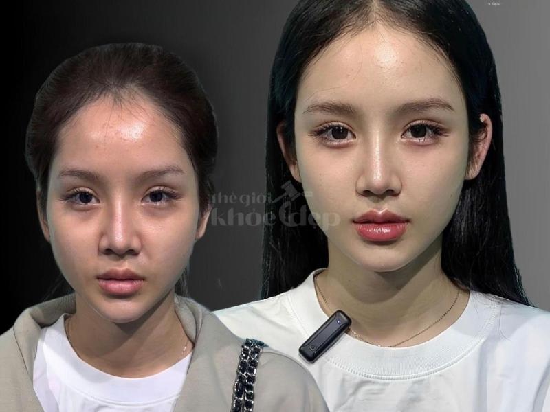 Má đầy đặn – gương mặt trẻ trung, phúc hậu và thu hút tài lộc với tiêm má Baby. - 4/4