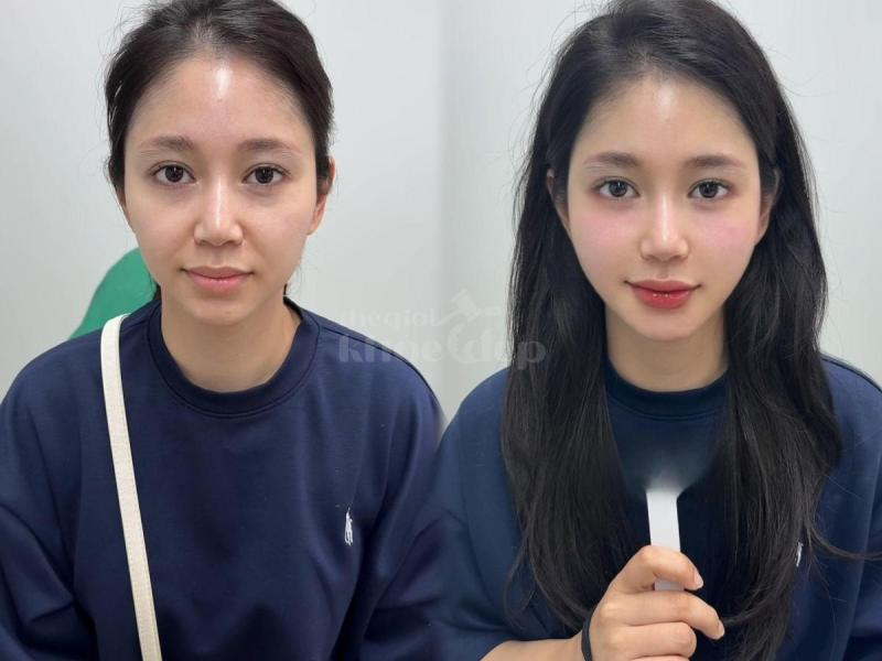 Mẹ bỉm sau sinh má hóp, da chảy xệ – Tiêm má Baby giúp trẻ trung, tự tin trở lại chỉ sau 30 phút. - 1/4