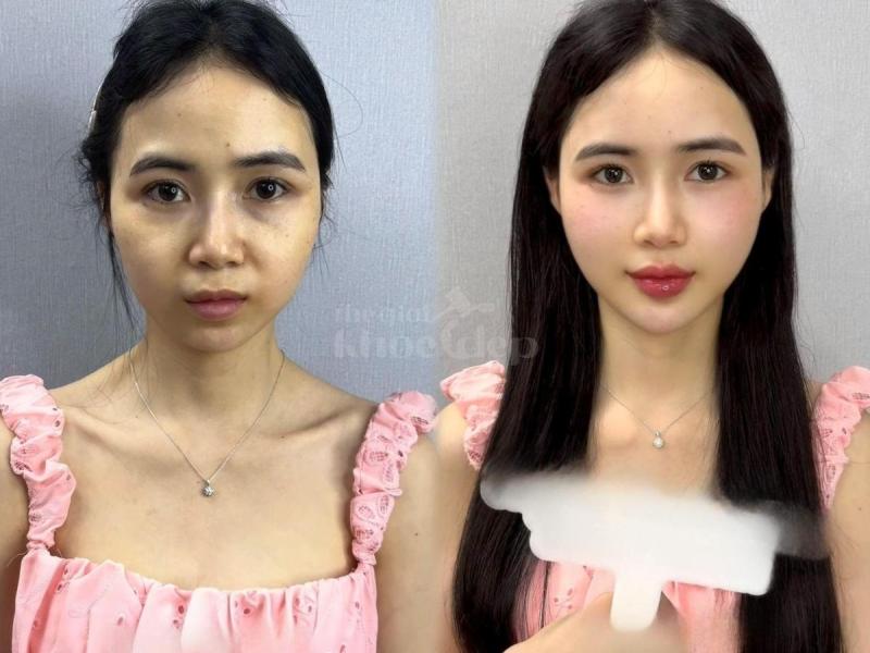 Mẹ bỉm sau sinh má hóp, da chảy xệ – Tiêm má Baby giúp trẻ trung, tự tin trở lại chỉ sau 30 phút. - 3/4