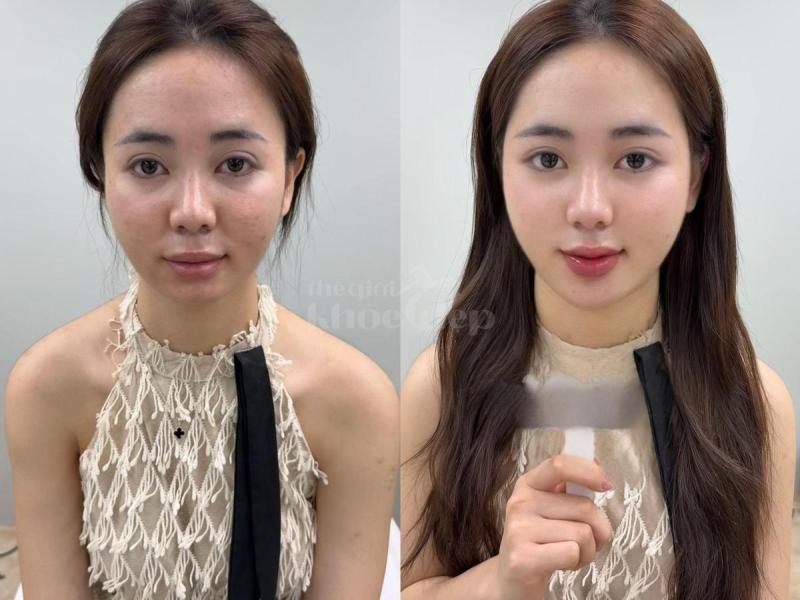 Mẹ bỉm sau sinh má hóp, da chảy xệ – Tiêm má Baby giúp trẻ trung, tự tin trở lại chỉ sau 30 phút. - 4/4