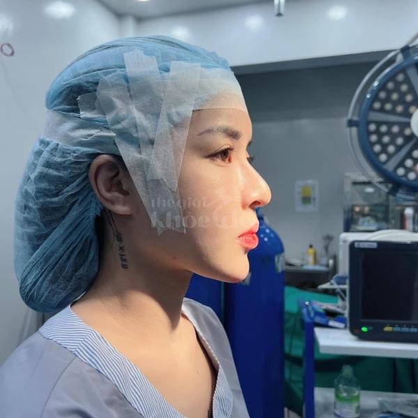 Nâng mũi cấu trúc 4D tự nhiên, an toàn – Giải pháp hoàn hảo cho dáng mũi đẹp lâu dài - 3/6