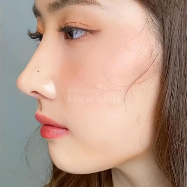 Nâng mũi cấu trúc 4D tự nhiên, an toàn – Giải pháp hoàn hảo cho dáng mũi đẹp lâu dài - 4/6