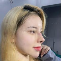 Nâng mũi S-Line 4D – Dáng mũi cao thanh thoát, chuẩn tỷ lệ vàng gương mặt