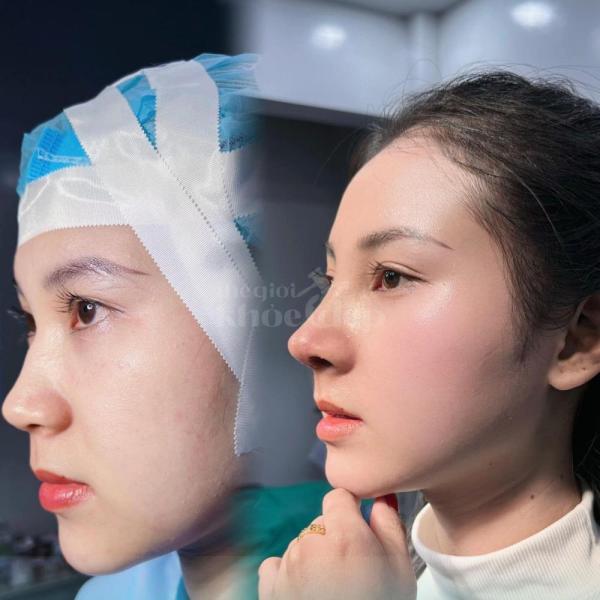 Nâng mũi S-Line 4D – Dáng mũi cao thanh thoát, chuẩn tỷ lệ vàng gương mặt - 5/5