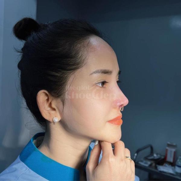 Nâng mũi cấu trúc 6D – Giải pháp tái sinh dáng mũi đẹp chuẩn và bền vững - 2/4