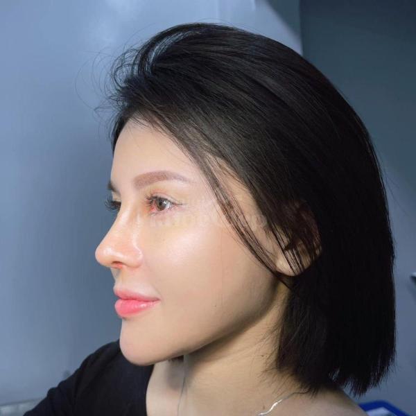 Nâng mũi cấu trúc 6D – Giải pháp tái sinh dáng mũi đẹp chuẩn và bền vững - 3/4