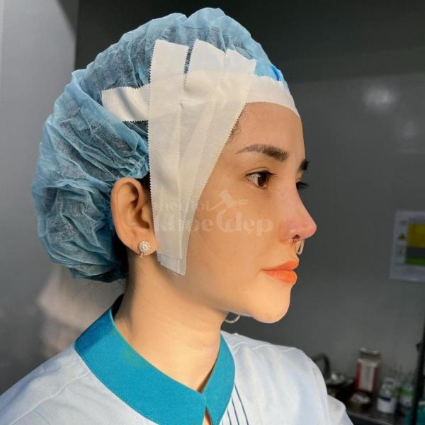 Nâng mũi cấu trúc 6D – Giải pháp tái sinh dáng mũi đẹp chuẩn và bền vững - 4/4