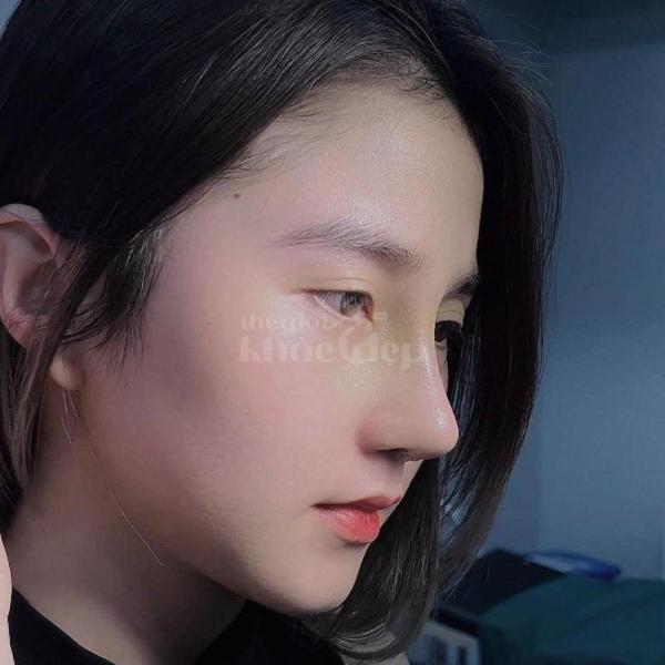 Phẫu thuật nâng mũi đẹp – Giải pháp chuẩn cho gương mặt thanh tú, sang trọng - 2/4