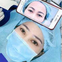 Cắt mắt 2 mí an toàn – trẻ hóa đôi mắt, khắc phục sụp mí, lấy lại vẻ tự tin