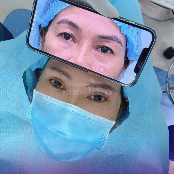 Nhấn mí Mini Deep 2026 – Bí quyết đôi mắt to tròn, trẻ trung tự nhiên - 3/3