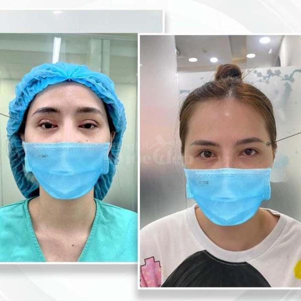 Cắt mí 2 mí & Nhấn mí Mini Deep – Trẻ hóa ánh mắt tự nhiên, an toàn - 3/3