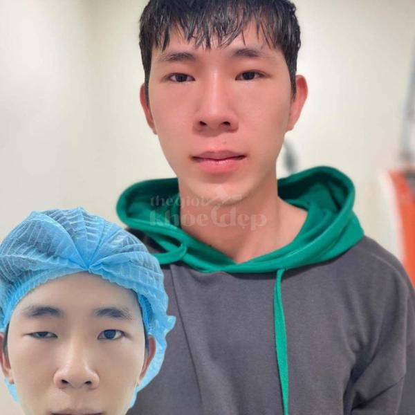 Nhấn mí Mini Deep & Cắt mí 2 mí – Giải pháp mắt đẹp to tròn, tự nhiên - 2/3