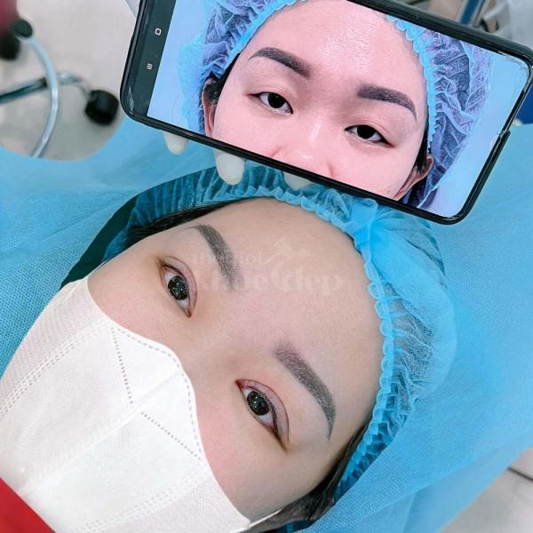 Nhấn mí Mini Deep & Cắt mí 2 mí – Giải pháp mắt đẹp to tròn, tự nhiên - 1/3