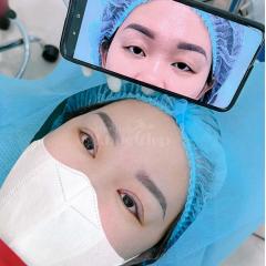 Nhấn mí Mini Deep & Cắt mí 2 mí – Giải pháp mắt đẹp to tròn, tự nhiên