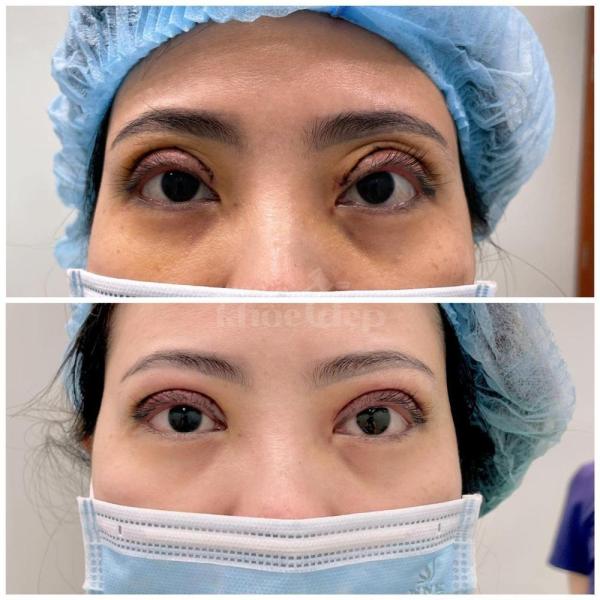 Nhấn mí Mini Deep & Cắt mí 2 mí – Giải pháp mắt đẹp to tròn, tự nhiên - 3/3