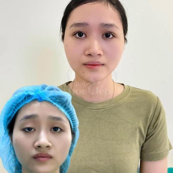 Cắt mí 2 mí & Nhấn mí Mini Deep – Khắc phục sụp mí, trẻ hóa đôi mắt - 1/3