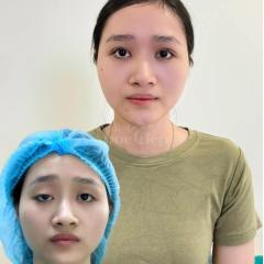 Cắt mí 2 mí & Nhấn mí Mini Deep – Khắc phục sụp mí, trẻ hóa đôi mắt