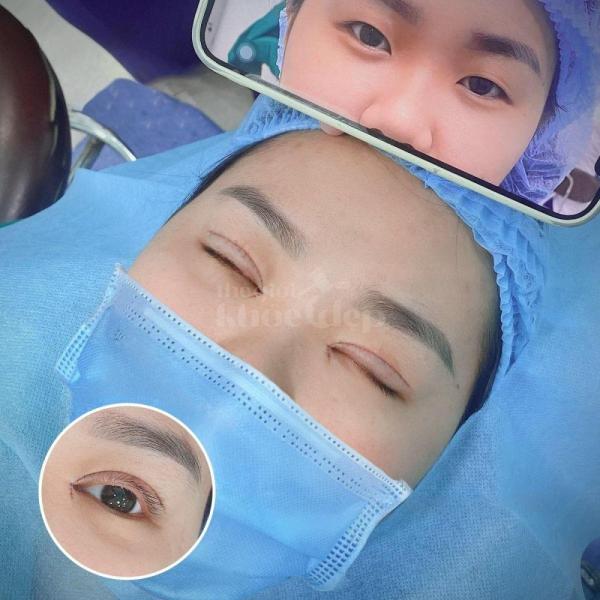 Cắt mí 2 mí & Nhấn mí Mini Deep – Khắc phục sụp mí, trẻ hóa đôi mắt - 2/3