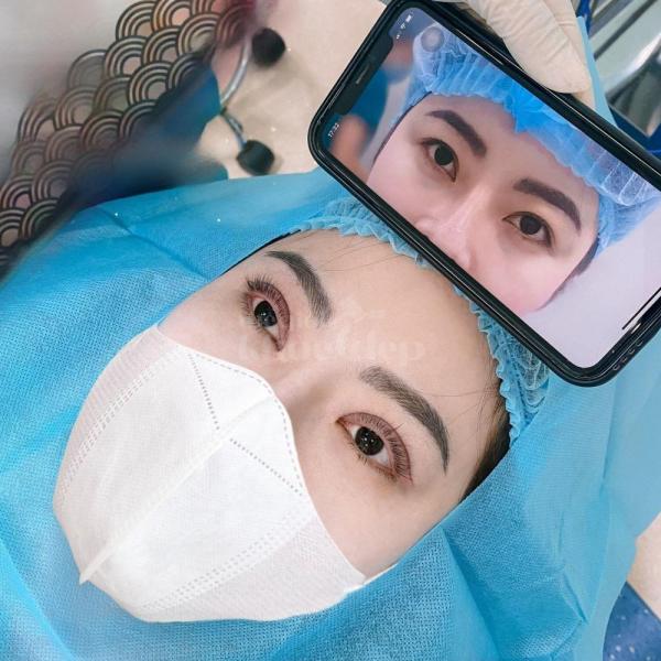 Cắt mí 2 mí & Nhấn mí Mini Deep – Khắc phục sụp mí, trẻ hóa đôi mắt - 3/3