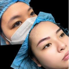 Cắt mí & Nhấn mí Mini Deep – Mắt to rõ mí, khắc phục mí lót hiệu quả