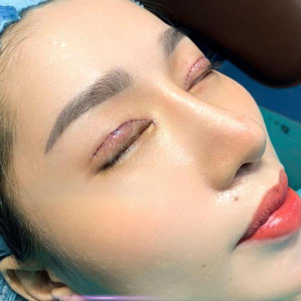 Cắt mí & Nhấn mí Mini Deep – Mắt to rõ mí, khắc phục mí lót hiệu quả - 3/3