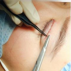 Cắt mí & Nhấn mí Mini Deep – Hết sụp mí, mắt sáng, trẻ trung