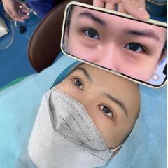 Sửa cắt mí hỏng, mí lệch bằng công nghệ Cắt mí & Nhấn mí Mini Deep