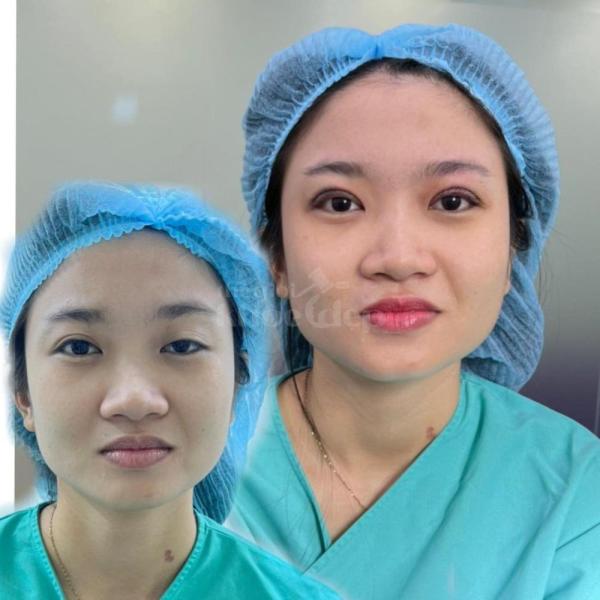 Sửa cắt mí hỏng, mí lệch bằng công nghệ Cắt mí & Nhấn mí Mini Deep - 2/3