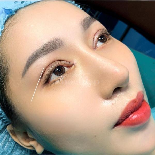 Sửa cắt mí hỏng, mí lệch bằng công nghệ Cắt mí & Nhấn mí Mini Deep - 3/3