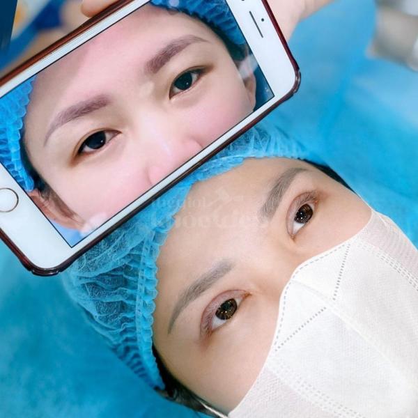 Cắt mí – Nhấn mí Mini Deep: Đôi mắt 2 mí đẹp tự nhiên, trẻ trung - 3/4