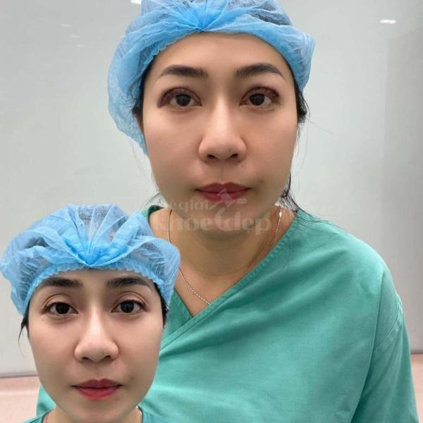 Cắt mí – Nhấn mí Mini Deep: Đôi mắt 2 mí đẹp tự nhiên, trẻ trung - 4/4